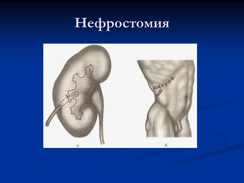 Нефростомия